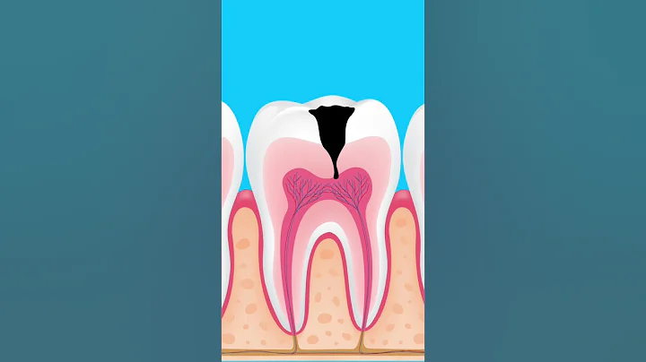 What happens if tooth decay is left untreated - DayDayNews