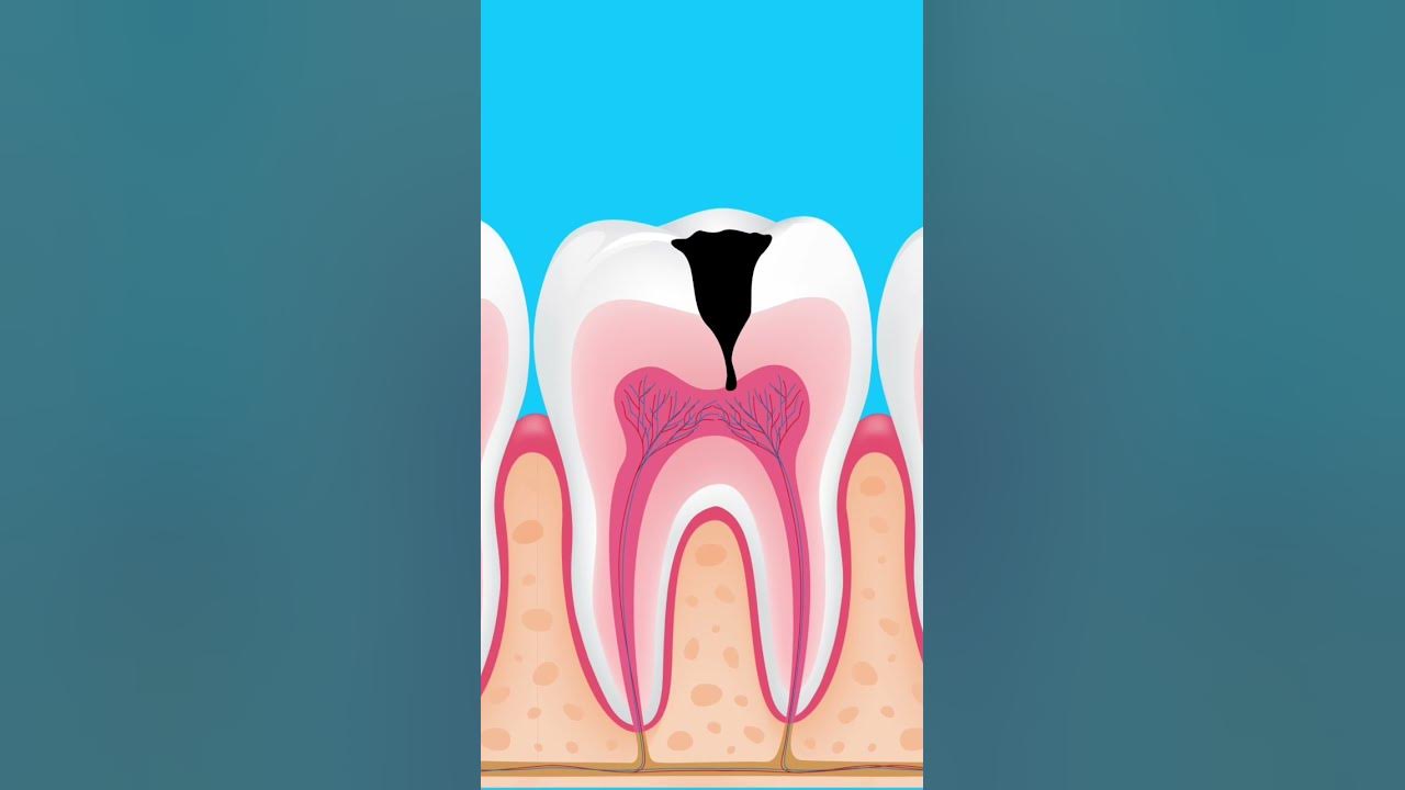 What happens if tooth decay is left untreated What happens if tooth decay is left untreated