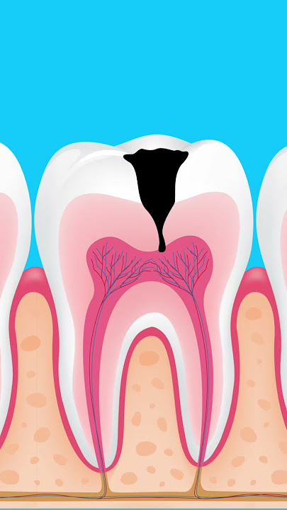 What happens if tooth decay is left untreated