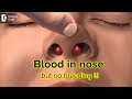 What to do for blood in my nose but there is no bleeding  drharihara murthy