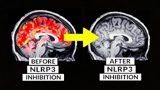 We weten eindelijk hoe we hersenontsteking op een natuurlijke manier kunnen stoppen