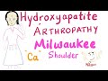 Hydroxyapatite Arthropathy | Milwaukee Soulder