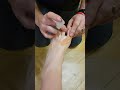 Taping for painful ingrown