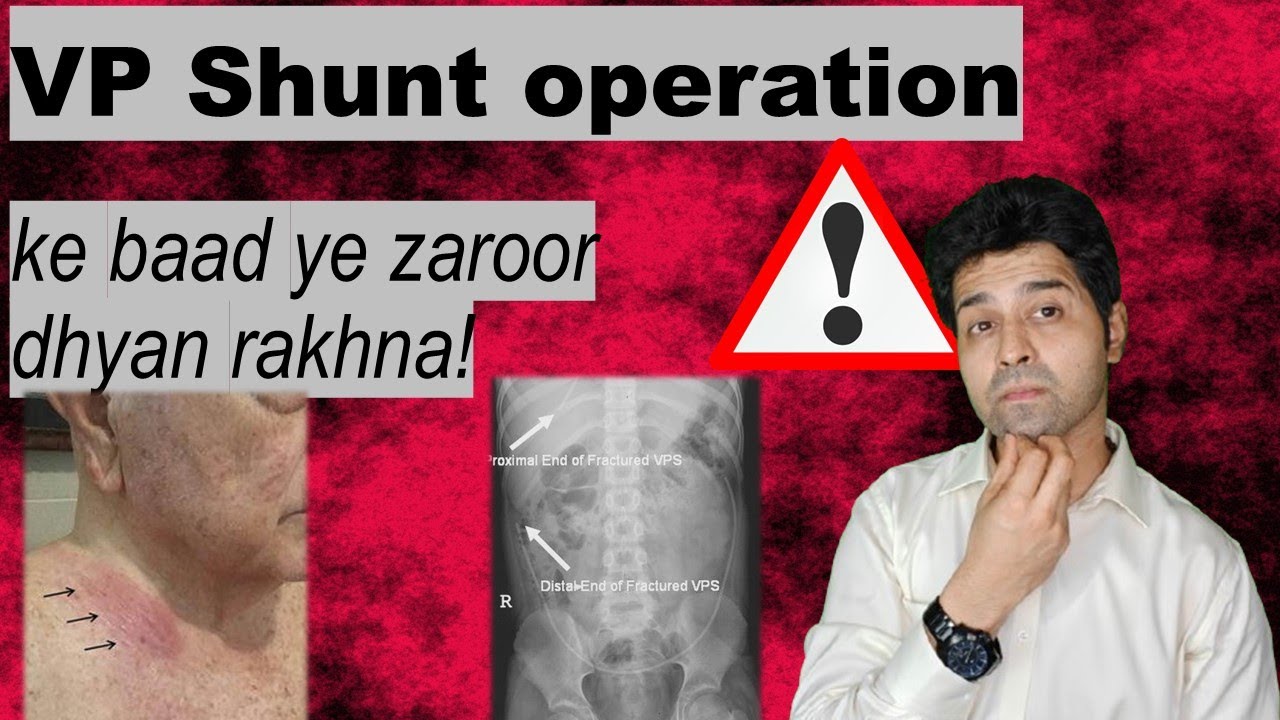 VP Shunt operation ke baad ye zaroor dhyan rakhna. warning signs