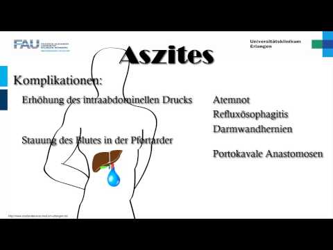 Video: Wassersucht Des Abdomens (Wassersucht Des Abdomens) - Ursachen, Symptome Und Behandlung