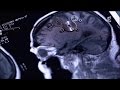 Accidents vasculaires cérébraux, les bons réflexes - Enquête de santé le documentaire