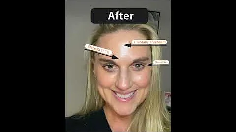 7 Day Botox Results - Tiffanie