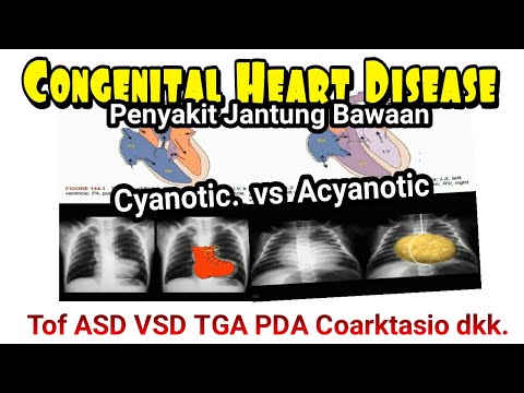 Congenital Heart Disease TOF, PDA, ASD, VSD, Coartation Aorta, TGA, Pulmonary Aortic Stenosis UKMPPD