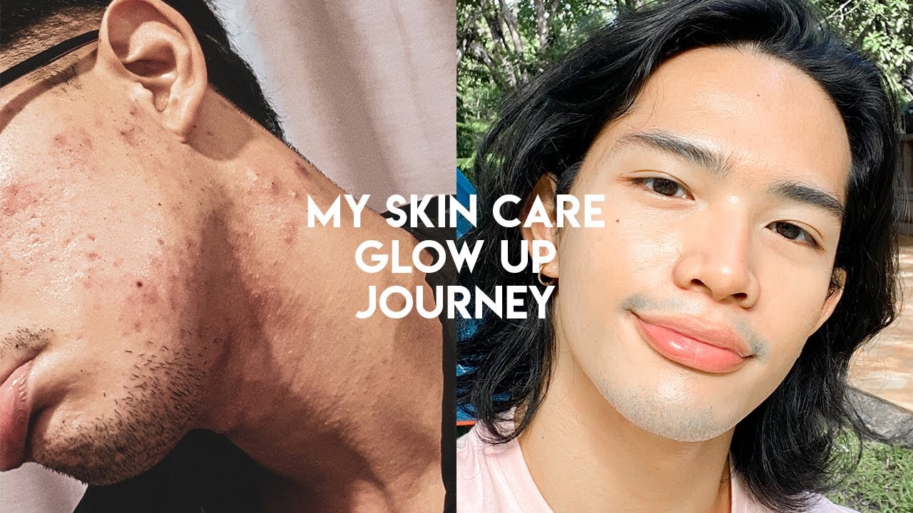 MY SKINCARE GLOW UP JOURNEY | HOW I CLEARED MY SKIN FROM SEVERE ACNE ...