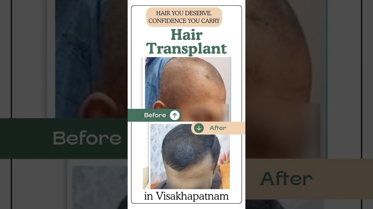 Where Experience Meets Transformation | Hair Transplant in Vizag | VJ Clinics