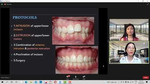 ĐIỀU TRỊ CÁC CA SAI KHỚP CẮN HẠNG 2, 3 VỚI HỆ THỐNG INVISALIGN