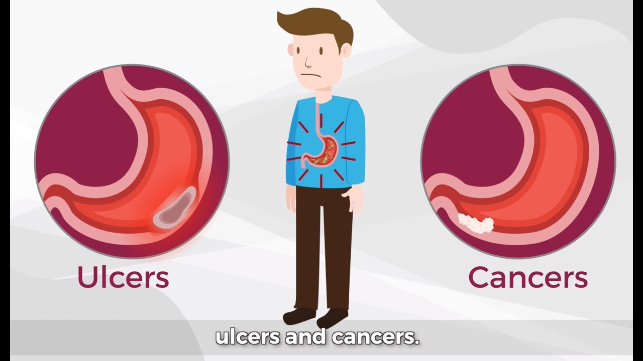 Helicobacter Pylori 101: The Bacteria That Can Cause Stomach Cancer | gutCARE