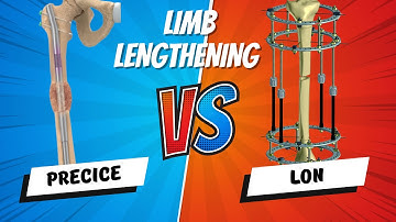 Limb Lengthening Devices: PRECICE vs LON