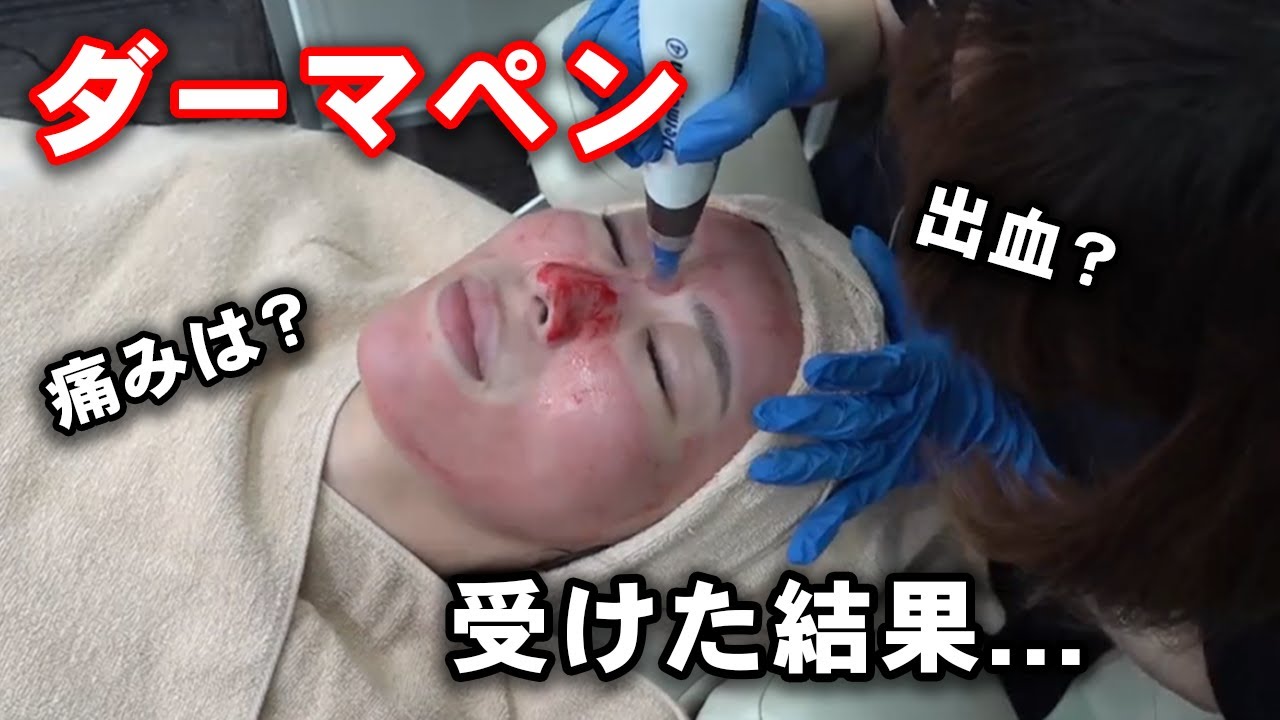 ダーマペン4（ヴェルベットスキン）｜福岡市博多区の美容皮膚科【あや
