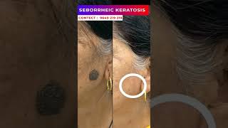 Seborrheic Keratosis Treatment At Skinaa Clinic 