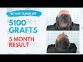 ASMED - Dr. Koray Erdogan - 5100 Grafts (Manual FUE) - 5 Month Hair Transplant Result