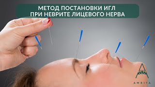 Иглорефлексотерапия при неврите лицевого нерва