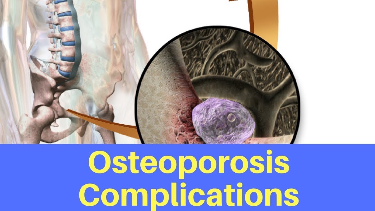 Osteoporosis Complications 