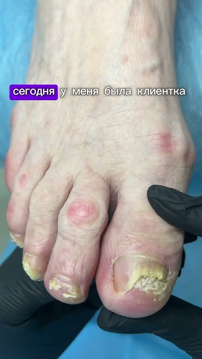 Грибковое поражение ногтей,обработка - YouTube