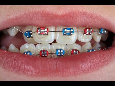 รูป เหล็ก ดัด ฟัน  Update 2022  จัดฟัน ฟันเคลื่อนเร็วมาก! Braces moving teeth too fast?