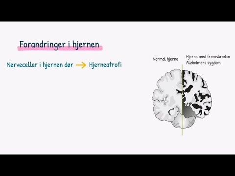 Video: Cerebrovaskulær Sygdom: Forventet Levetid, Behandling Og Prognose