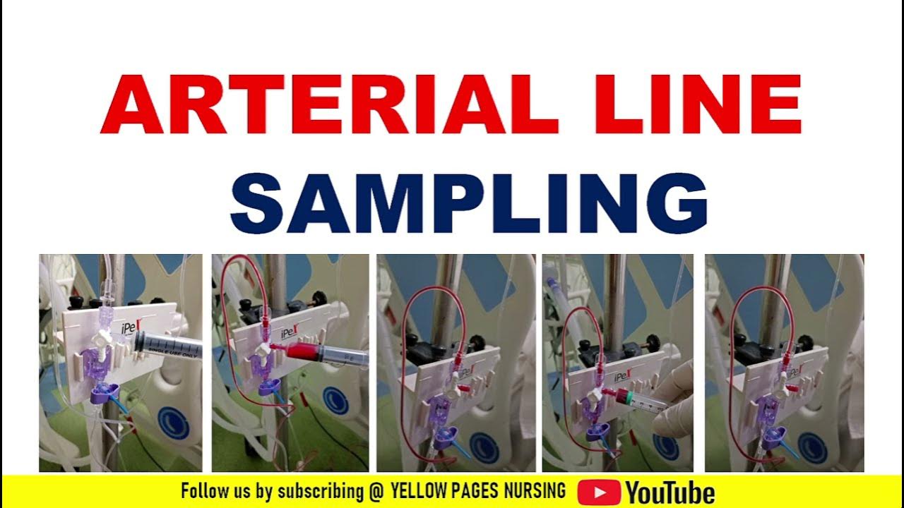 Arterial line sampling ABG sampling from Arterial line Arterial line