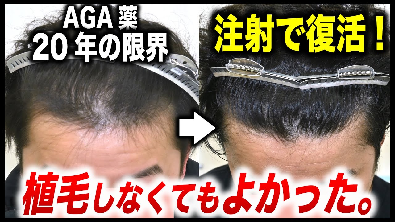 AGA薬を20年飲み続けた結果、悪化しました。薬の限界を感じた40代が注射の再生治療でここまで変化【湘南AGA仙台院 藤井医師】｜No.177