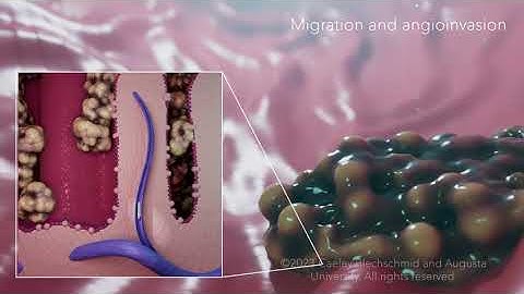 Cell Migration: Cancer