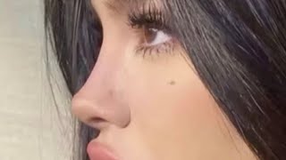 ⊹ High Nose Bridge + Nasal Structural Elevation. [1 𝒽𝓇 Results] 💉