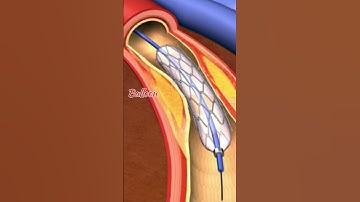 Thumbnail of Angioplasty | Angiography | Coronary Angioplasty | #who #worldhealthorganization #angioplasty