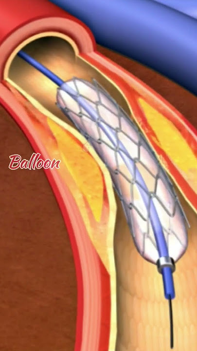 Angioplasty | Angiography | Coronary Angioplasty | #who #worldhealthorganization #angioplasty