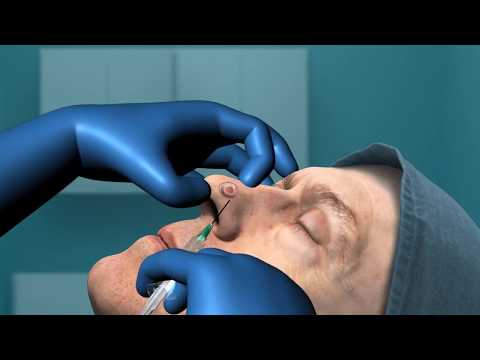 Mohs Surgery