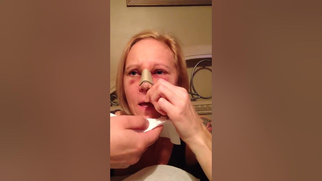 Removing the Packing after Nose Surgery YouTube