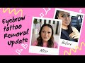 Eyebrow Tattoo Removal Update!! + Q&A