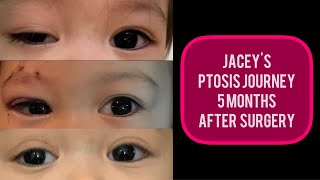 CONGENITAL PTOSIS | JACEY'S PTOSIS JOURNEY | 5 MONTHS AFTER SURGERY