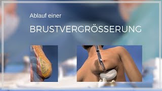 Was kostet eine Brustvergrösserung mit Eigenfett? I clinic utoquai