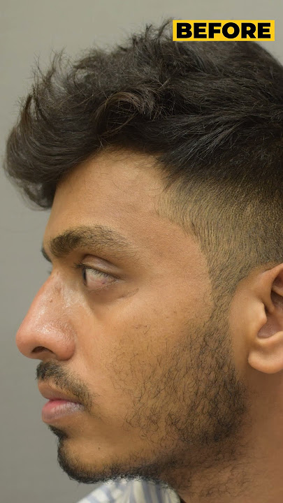 'From Patchy to Perfect: The Incredible Before & After of Beard Transplant'