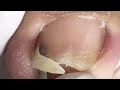 Cut Off Two Large Pieces Of Squeezed Ingrown Nails