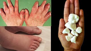 10 मिनट में सूजन को दूर करने का 100% इलाज |  Pairo Me Sujan Ka ilaj | Swelling in Feet