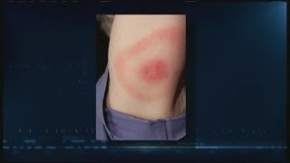 Protecting yourself from Lyme disease