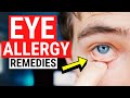 Eye Allergy Remedies - Tips for Itchy and Watery Eyes