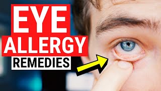 Eye Allergy Remedies - Tips for Itchy and Watery Eyes Resimi