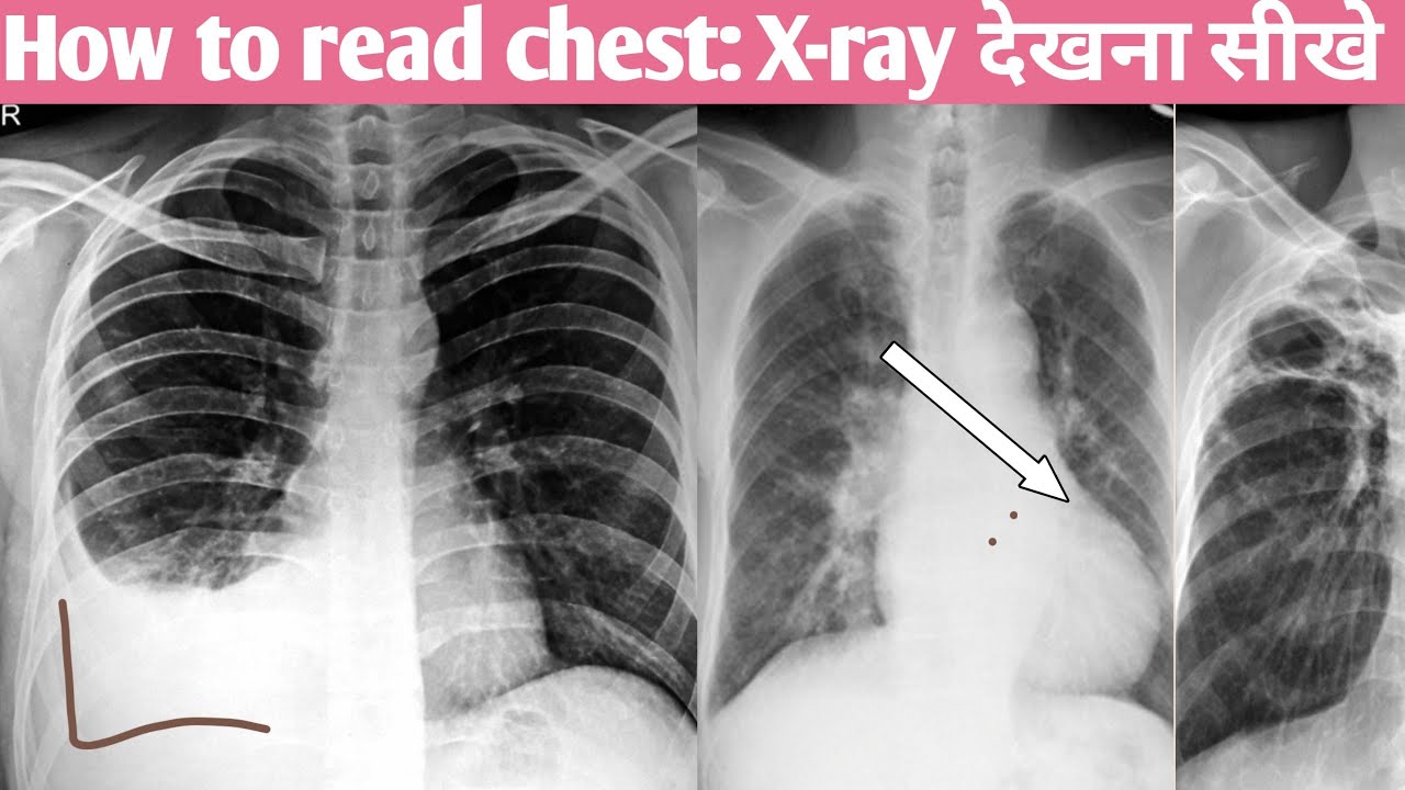 How to read xray of chest in hindi reading a chest xray chest_x