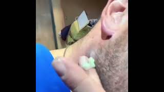 pimple popping cyst removal blackhead removal satisfying