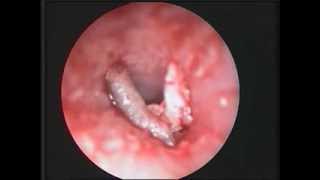 Fruit-fly Larva in the Auditory Canal | NEJM