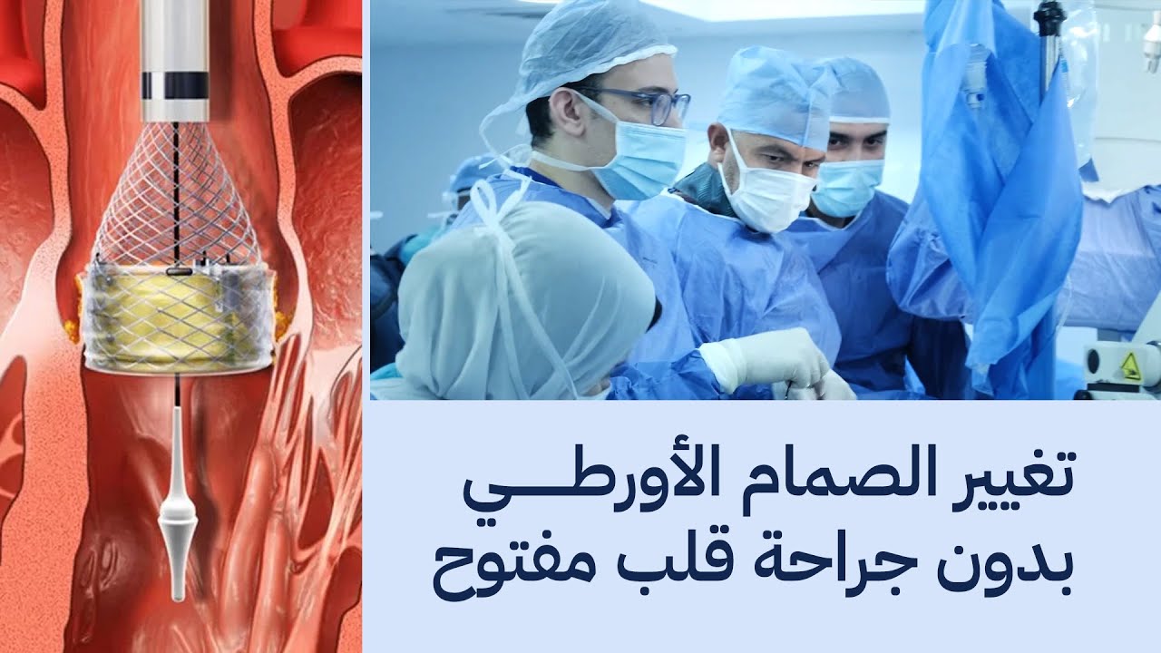 TAVI | تغيير الصمام الأورطي بدون جراحة قلب مفتوح