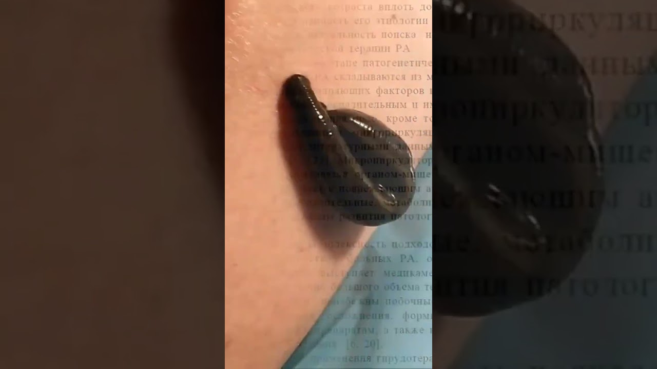 Пиявки улучшают микроциркуляцию и регулируют систему свертываемости крови при ревматоидном артрите