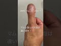 バチ指は持病によるものが多く、マムシ指は持病の恐れはありません。　#バチ指
