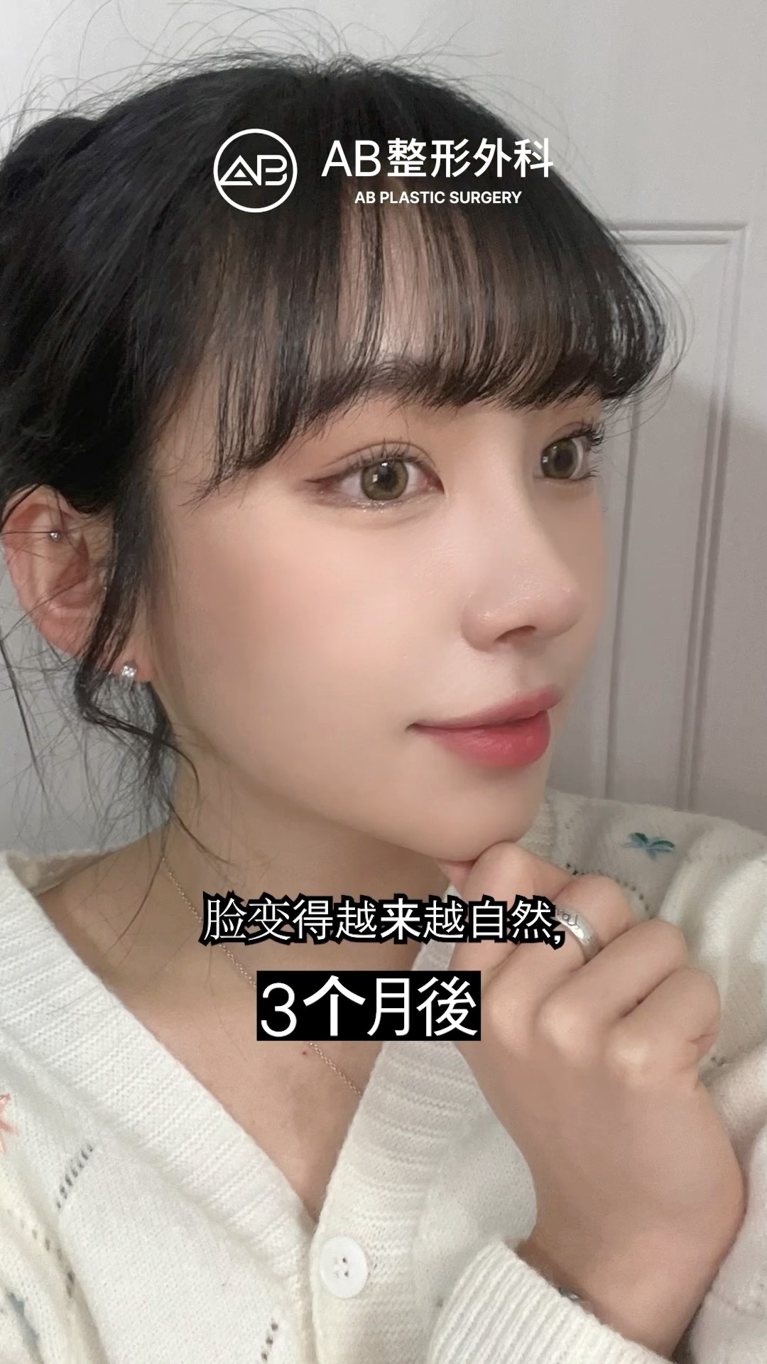 雙眼皮＋隆鼻修復手術後, 她的變化讓人驚嘆! #shorts