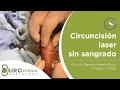 Circuncision laser sin bisturi sin sangrado sin suturas tratamiento fimosis